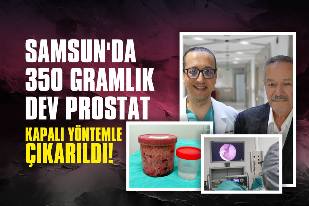 Samsun'da 350 Gramlık Dev Prostat Kapalı Yöntemle Çıkarıldı!