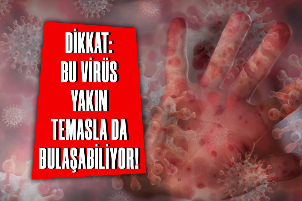 Dikkat: Bu Virüs Yakın Temasla da Bulaşabiliyor!